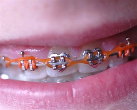 Different Kinds Of Braces For Teeth - Teeth Poster