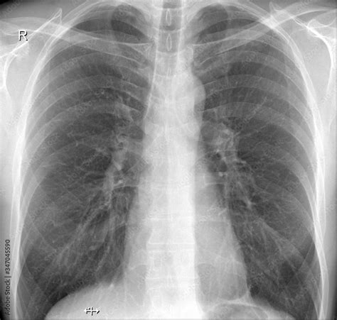 X-ray of a human lungs and chest of a healthy person. In the picture we can see clean lungs ...