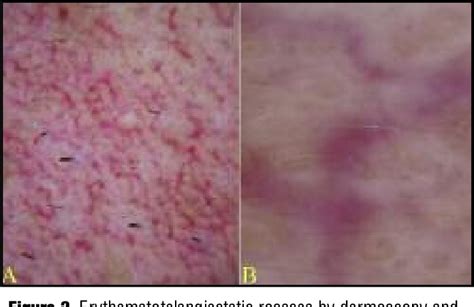 Figure 2 From Improving Treatment Of Erythematotelangiectatic Rosacea