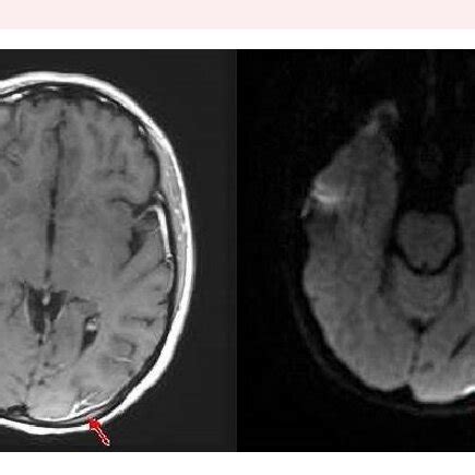 Magnetic Resonance Imaging Brain Axial T Weighted Post Contrast Left