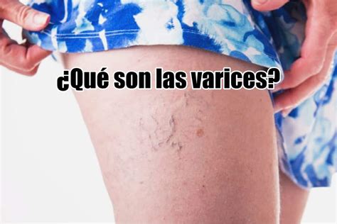 ¿qué Son Las Varices Síntomas Causas Y Tratamiento