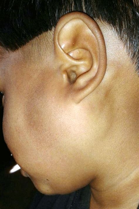 Swollen Parotid Gland On One Side