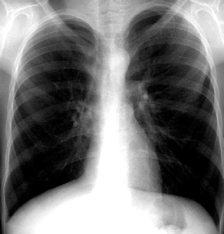 A Postero Anterior Chest Radiograph Inconsiderable Peribronchial