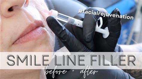 Smile Line Filler Before And After Derma Noor Med Spa Youtube