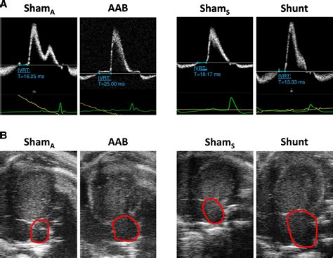 Echocardiographic Evaluation Of Diastolic Function In Mouse Models Of