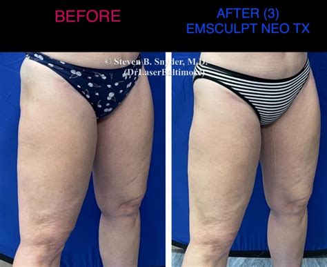 Emsculpt Neo Next Generation Body Contouring Elite Body And Laser