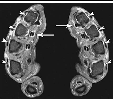 Transverse Fat Suppressed Gadolinium Enhanced T1weighted Se Mr Image