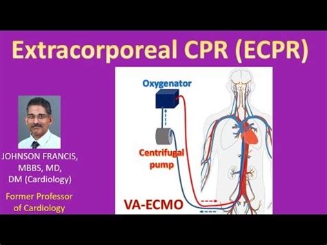 Extracorporeal Cpr Ecpr Youtube