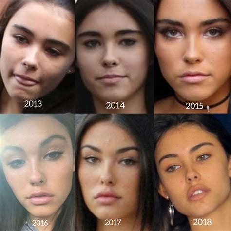 Madison Beer Lip Filler Face Lift Eyebrow Lift Canthoplasty Foxy