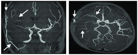 3D-TOF MRA. Coronal (4A), Axial (4B): EDAS procedure, improvement of... | Download Scientific ...