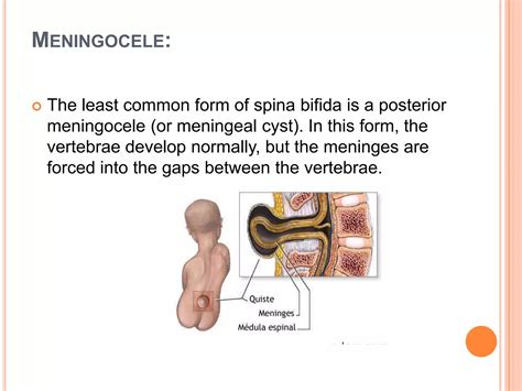 Spinal Bifida Ppt