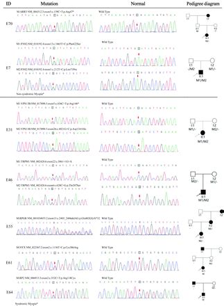 Trio Based Whole Exome Sequencing Reveals Mutations In Early Onset High