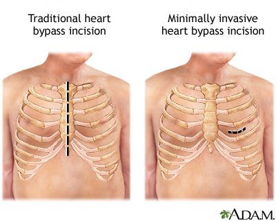 Heart Bypass Surgery Incision Medlineplus Medical Encyclopedia Image