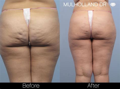 Cellulite Reduction Before After Gallery SpaMedica