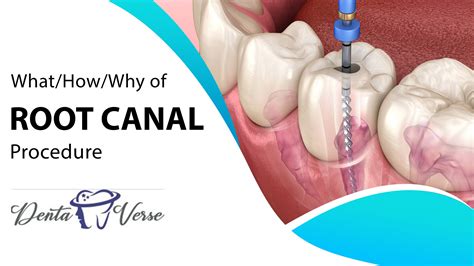 Root Canal Treatment In Hadapsar Pune Kharadi At Dentaverse Clinic