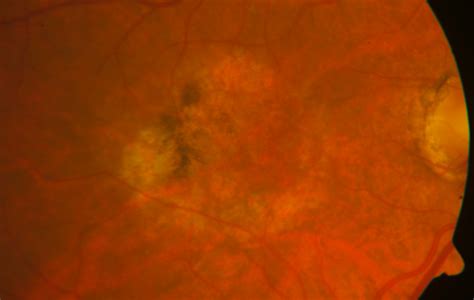 Age Related Macular Degeneration