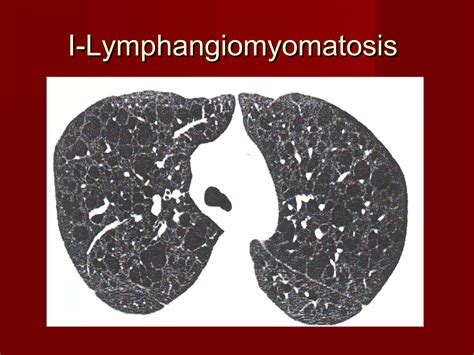 Diffuse Lung Diseases Clinical Features Pathology 12