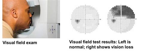 Glaucoma Field Test Eye Physicians Of Washington