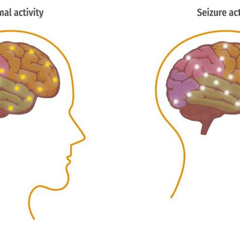 Epilepsy Brain Diagram