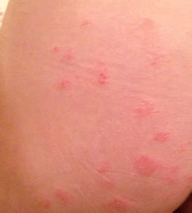 Itchy Blister Rash On Buttocks