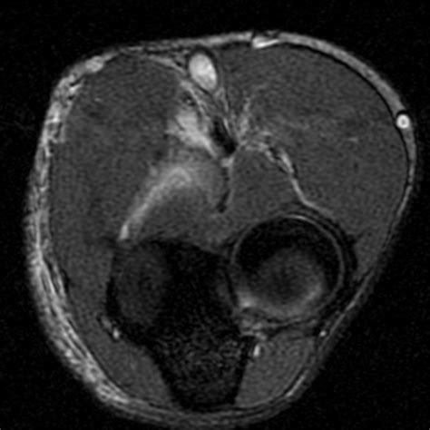 Radiopaedia case Brachialis muscle injury id: 15701 study: 15349 - NC ...