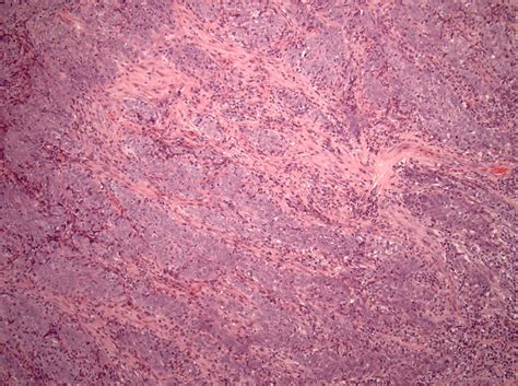 Pathology Outlines Nasopharyngeal Carcinoma