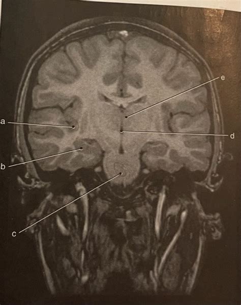 MRI of cerebral lobes Diagram | Quizlet