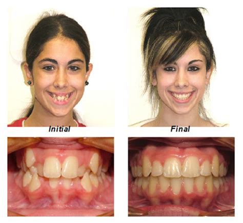 Smile Gallery Millburn Nj Millburn Orthodontics