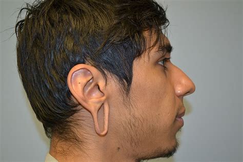 Gauged Earlobe Repair - Patients Before and After - Atlanta Plastic Surgery Specialists