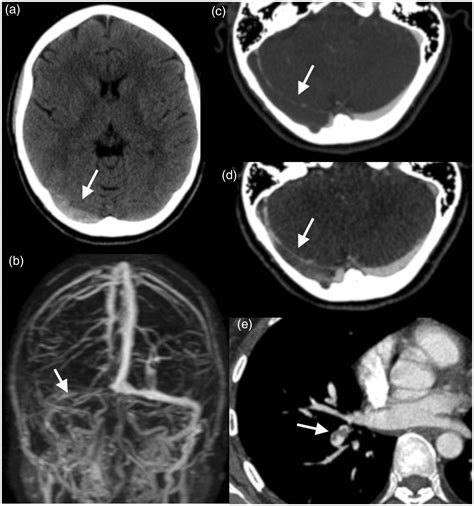 Transverse Sinus Thrombosis