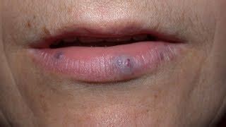 Melanoma Black Spots On Lips Lipstutorial Org