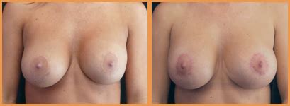 Corrective Breast Surgery Beverly Hills Julie Edween D O