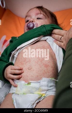 Roseola Ausschlag Ein Viraler Ausschlag Auf Der Haut Eines Kindes