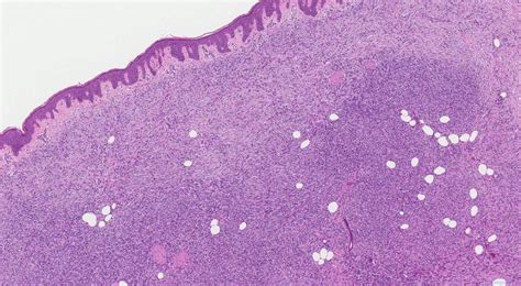 Dermatofibrosarcoma Pathology Outlines