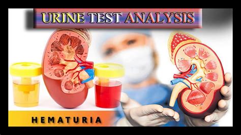 Urine Test Urinalysis Interpretation Explained Clearly By Harib Lab