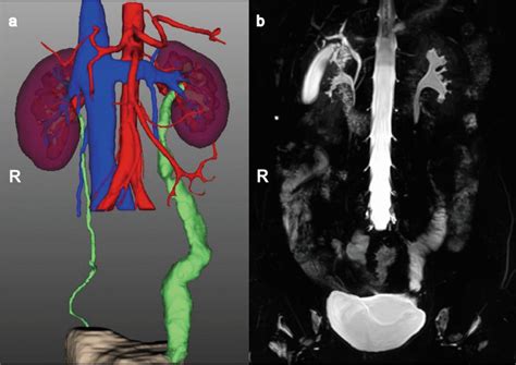 Postoperative Evaluation At The Follow Up 3d Ct Image Reconstruction Download Scientific