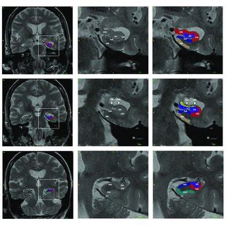 Example Of The Automatic Segmentation Of The Hippocampal Subfield