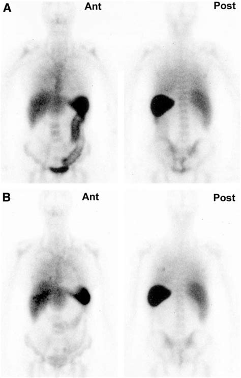 99m Tc Hmpao Wbc Whole Body Scintigraphy Patient 6 In Anterior Ant