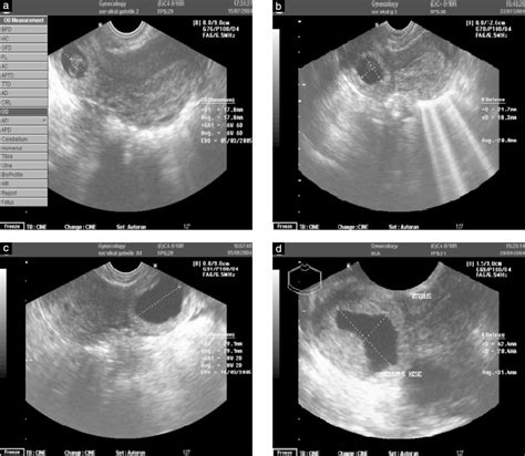 Ultrasonographic Appearance Of Cervical Pregnancy Following Successful