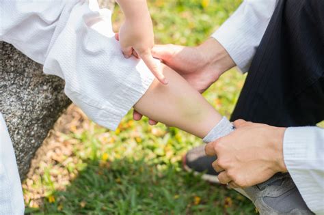 Co na siniaki na nogach twarzy i pod oczami Co stosować