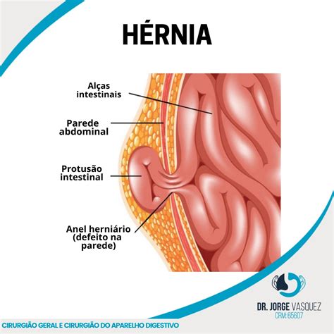 Hérnias da Parede Abdominal Tipos Riscos e Tratamentos