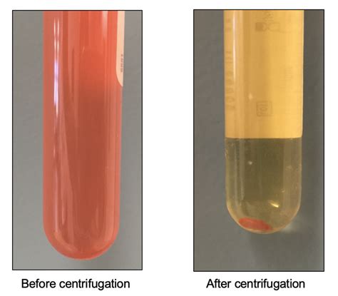 Serous Fluid Color