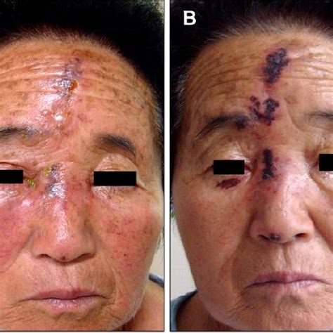 A Erythema Edema Vesiculobullous Eruptions Crusted Erosions Were