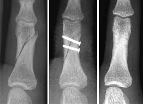 Case 1 A Simple Oblique Fracture Of The Proximal Phalanx In The Left