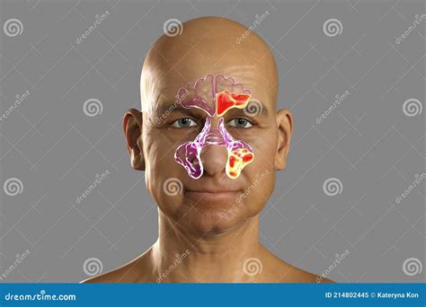 Purulent Inflammation Of Frontal And Maxillary Sinuses In A Man Stock