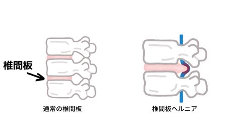 腰椎椎間板ヘルニア 天神橋筋六丁目天六駅の整形外科天6整形外科整形外科・リハビリ・骨粗しょう症・交通事故治療