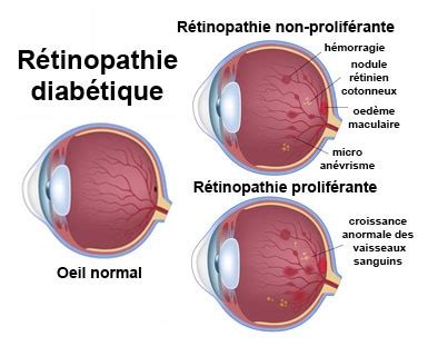 La rétinopathie diabétique Centre ophtalmologique Ultravision