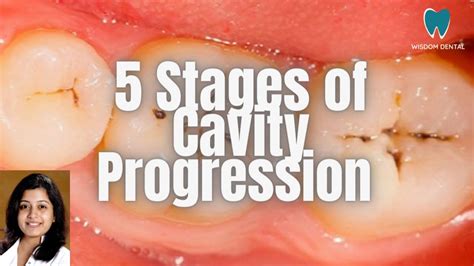 5 STAGES OF CAVITY PROGRESSION TOOTH DECAY TREATMENT OPTIONS