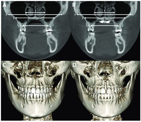 Linear Measurements Of The Maxilla Before And After Download