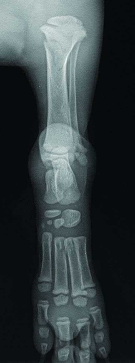 Definitive Treatment Of Limb Fractures With Splints Or Casts